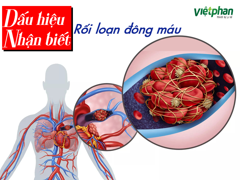 dấu hiệu nhận biết tình trạng rối loạn quá trình đông máu